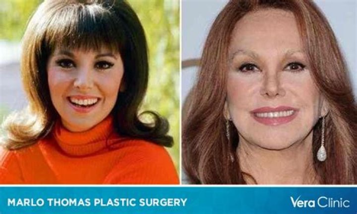 Unveiling The Truth Behind Marlo Thomas's Plastic Surgery Journey